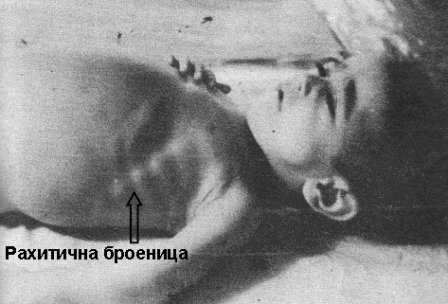 Рахит – признаци и симптоми | Zdrave-Bg.eu