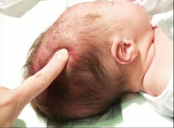 What is craniotabes? - Quora