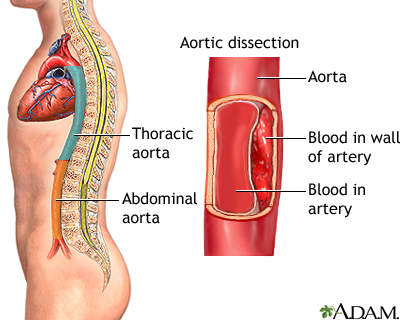 Aortic dissection: MedlinePlus Medical Encyclopedia