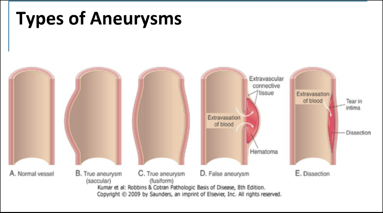Types of Aneurysms 
A. Nonnalvessel B. True aneurysm C. Trueamurysm D. FalWMEurysrn 
(fus.form) 
& CotrM Of 8th Edti•on. 
Copyright 0 2009 by *undes, .int Inc. rgns 
Tear in 
E. Dissection 