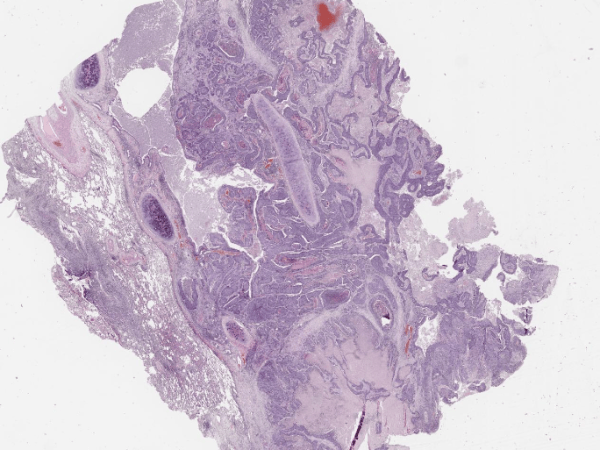 Плоскоклетъчен карцином на бронха
