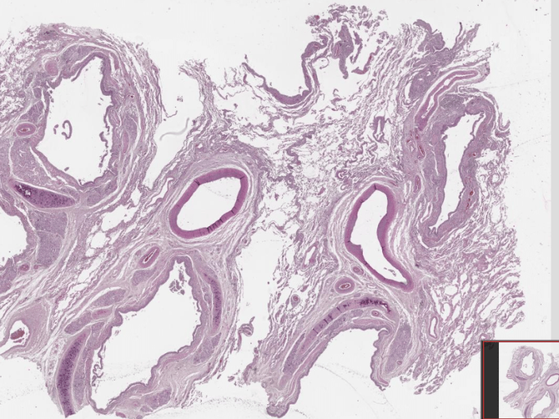 Бронхиектазии