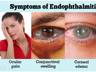 Ендофталмит