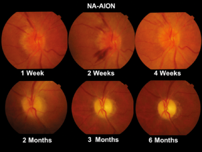 Предна исхемична оптикопатия